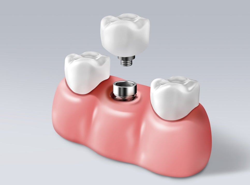 등촌역치과, 임플란트 수명은 무엇으로 결정될까? 관련 이미지 2