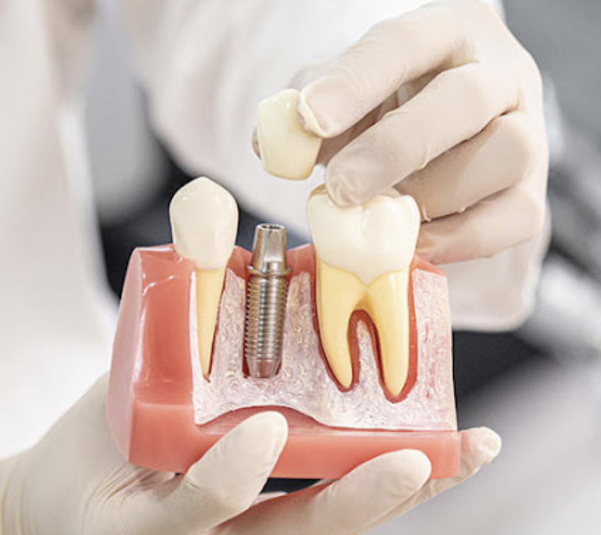 강서구청치과 임플란트 오래 쓰려면 피해야할 이것 관련 이미지 8