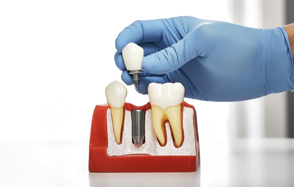 염창역 임플란트, 식립 각도의 차이가 치료 결과를 좌우합니다 관련 이미지 2