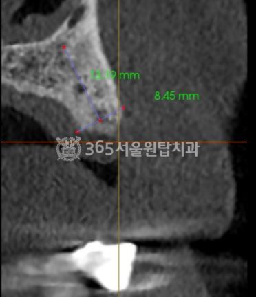 화곡동치과 2030 임플란트, 가격보다 중요한 체크리스트! 관련 이미지 5