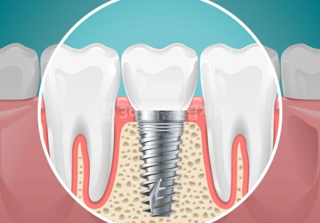 등촌역임플란트치과 수술 후 비행기 타도 괜찮을까? 관련 이미지 5