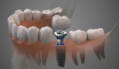 화곡역치과 치아가 빠진 개수만큼 임플란트를 심어야 될까? 관련 이미지 7