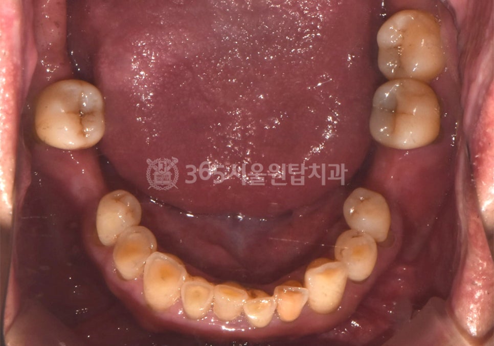 오목교 임플란트, 이갈이가 임플란트에 문제가 될 수 있나요? 관련 이미지 4