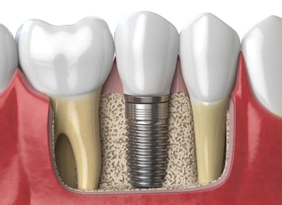 등촌역치과, 임플란트 수명은 무엇으로 결정될까? 관련 이미지 3