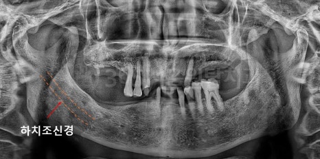 화곡동임플란트, 수술 전 CT에서 꼭 확인해야하는 3가지 관련 이미지 4