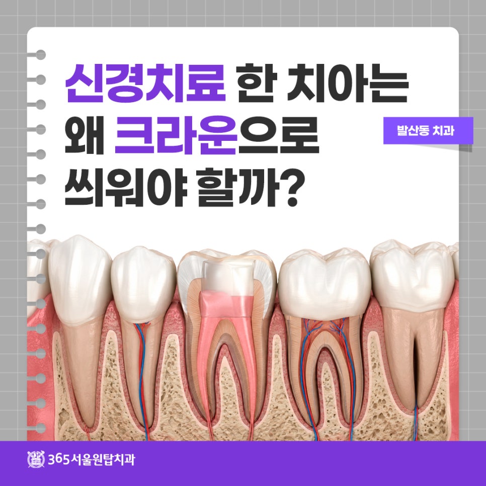 발산동치과, 신경치료 한 치아는 왜 크라운으로 씌워야 할까? 관련 이미지 7