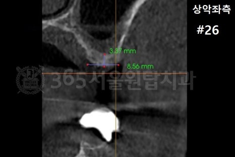 염창역 임플란트, 식립 각도의 차이가 치료 결과를 좌우합니다 관련 이미지 6
