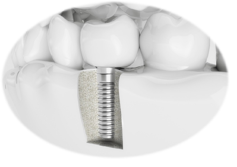 까치산임플란트 치과, 골다공증 약 복용 중 임플란트 가능할까? 관련 이미지 7