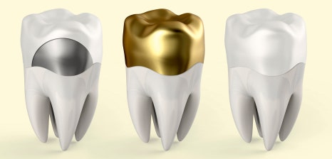 Yangcheon-gu Dental Clinic: 3 Problems That Can Occur If You Miss the Time to Replace Dental Prostheses image 4