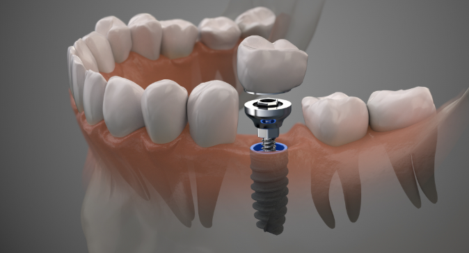 강서구청치과 임플란트 오래 쓰려면 피해야할 이것 관련 이미지 12