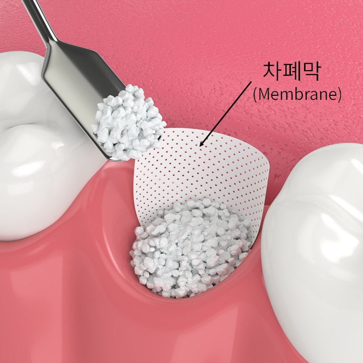 마곡임플란트 재수술, 이번이 마지막이 되려면? 관련 이미지 6