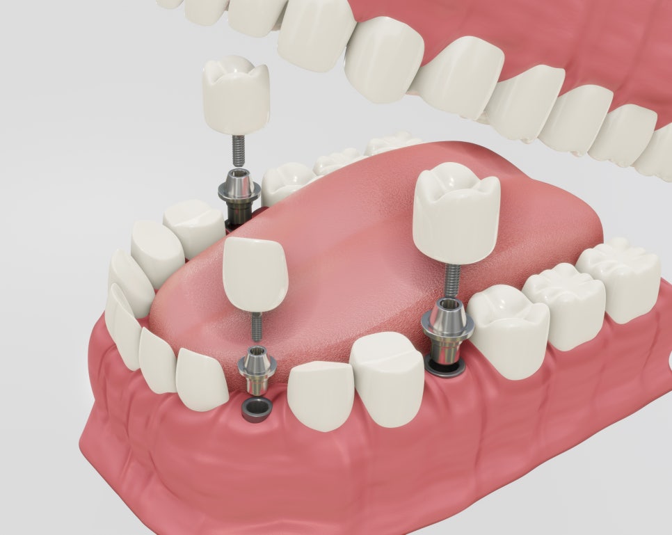 강서구임플란트, 치아 상실에 왜 임플란트가 필요할까 관련 이미지 3