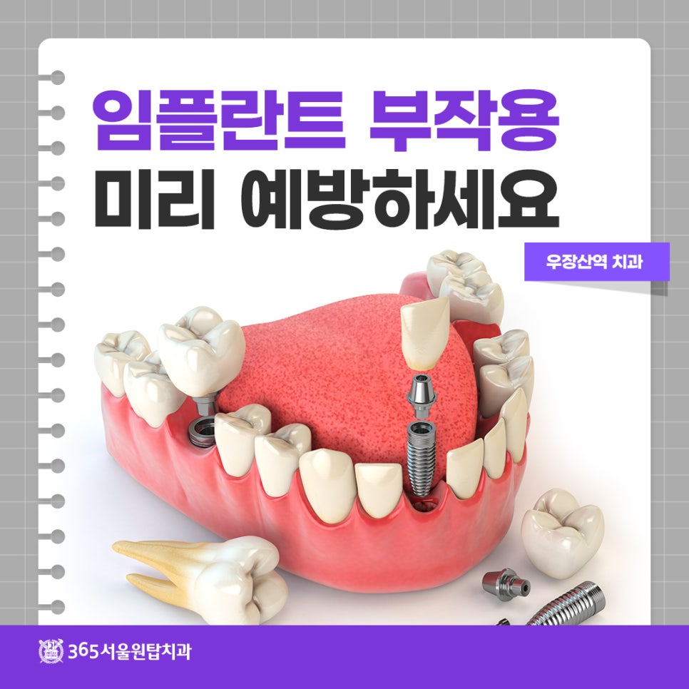 우장산역치과, 임플란트 부작용 미리 예방하세요 관련 이미지 11