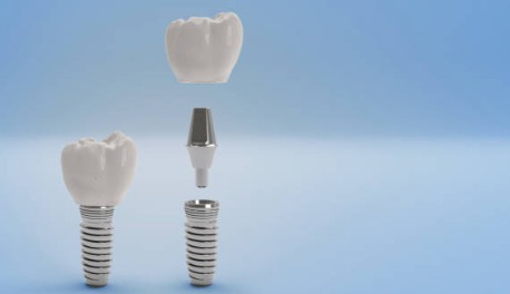 우장산치과 당뇨가 있어도 임플란트 가능할까요? 관련 이미지 11