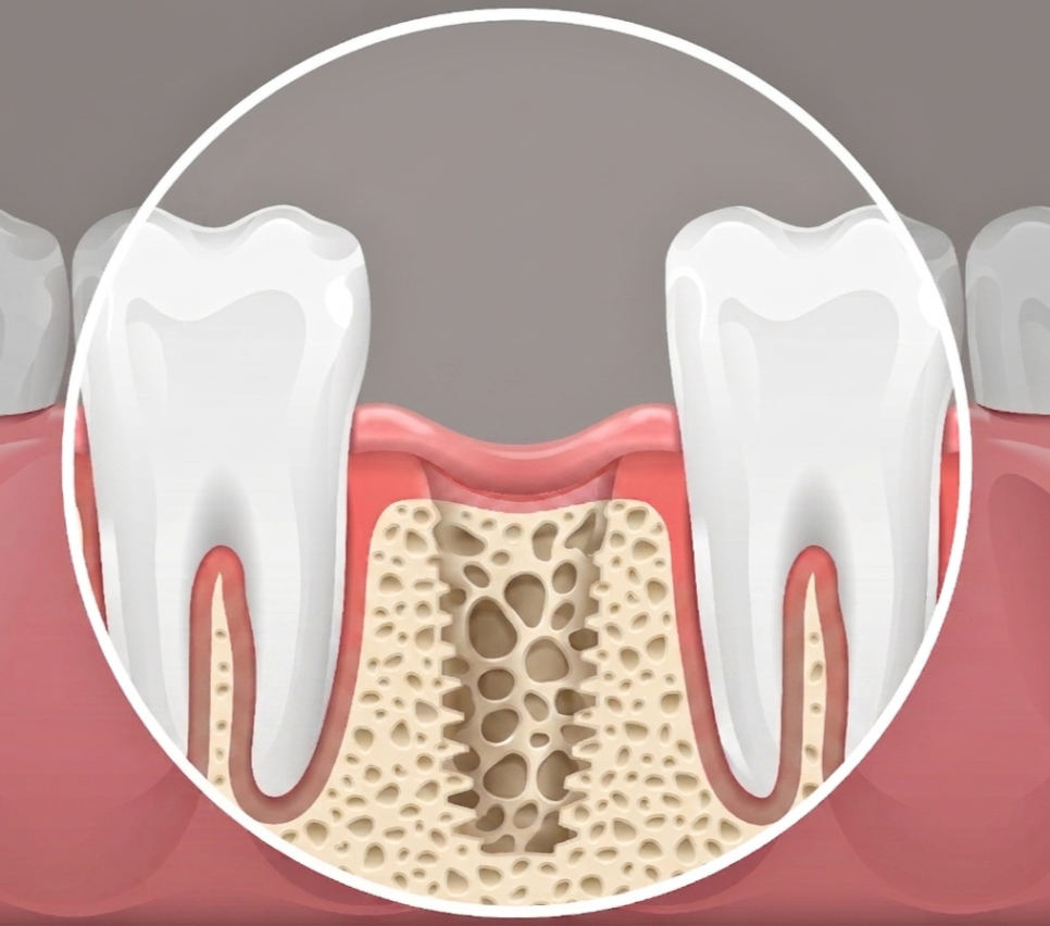 마곡임플란트 재수술, 이번이 마지막이 되려면? 관련 이미지 5