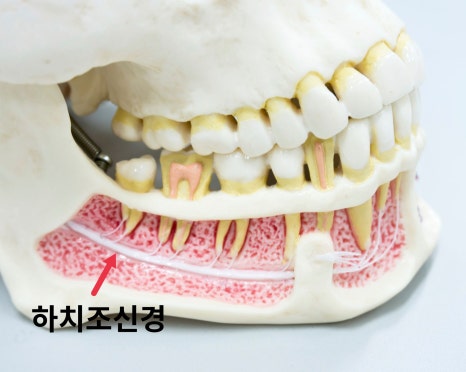 Balsan Station Dental Clinic: What If the Anesthesia Doesn’t Wear Off After Implant Surgery? image 4