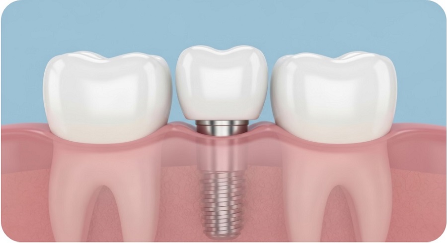 화곡역임플란트 수술 후 통증은 얼마나 갈까요? 관련 이미지 4
