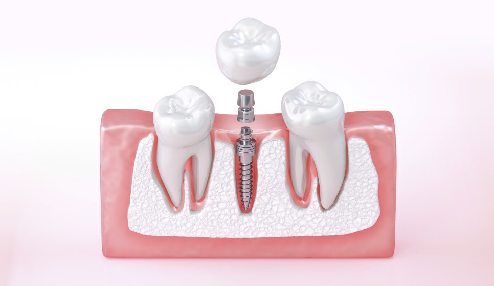 우장산역치과, 임플란트 부작용 미리 예방하세요 관련 이미지 4