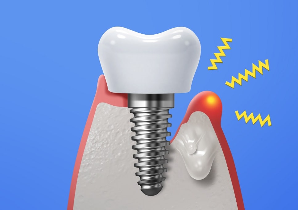 우장산역치과, 임플란트 부작용 미리 예방하세요 관련 이미지 3