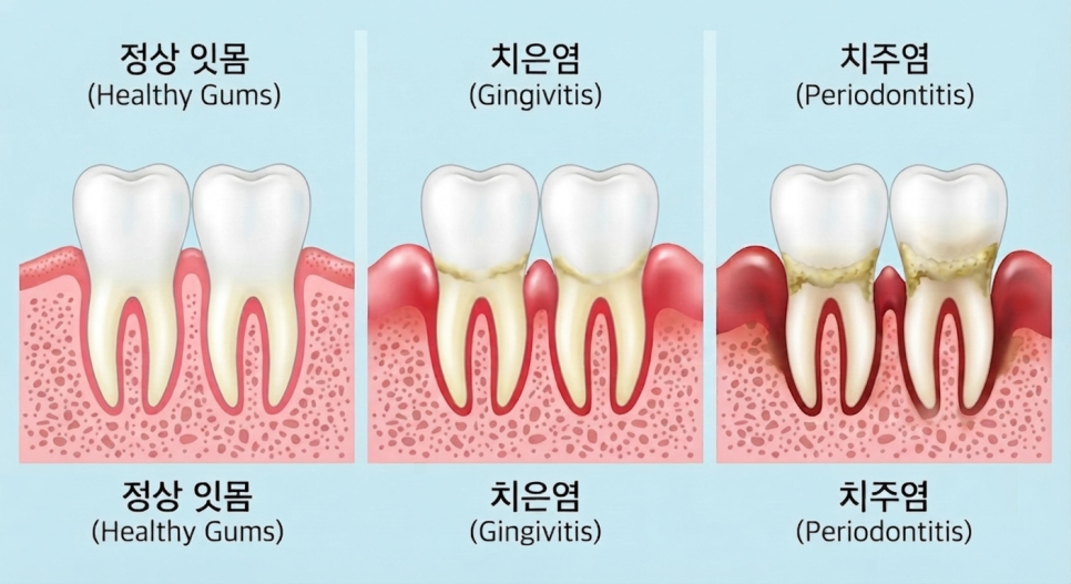화곡동 임플란트, 잇몸에서 피가 나는 이유? 관련 이미지 5