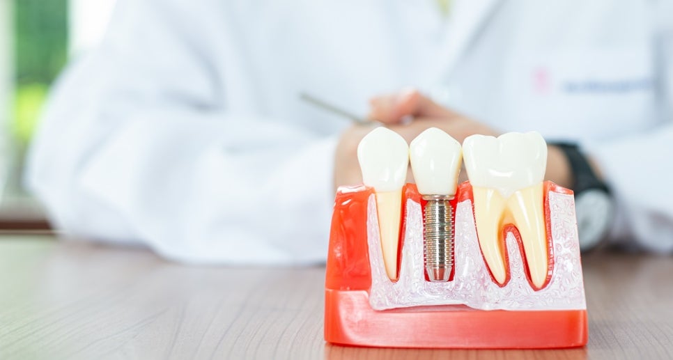 신월동임플란트, 치아 상실이 뇌 건강에 미치는 영향 관련 이미지 8