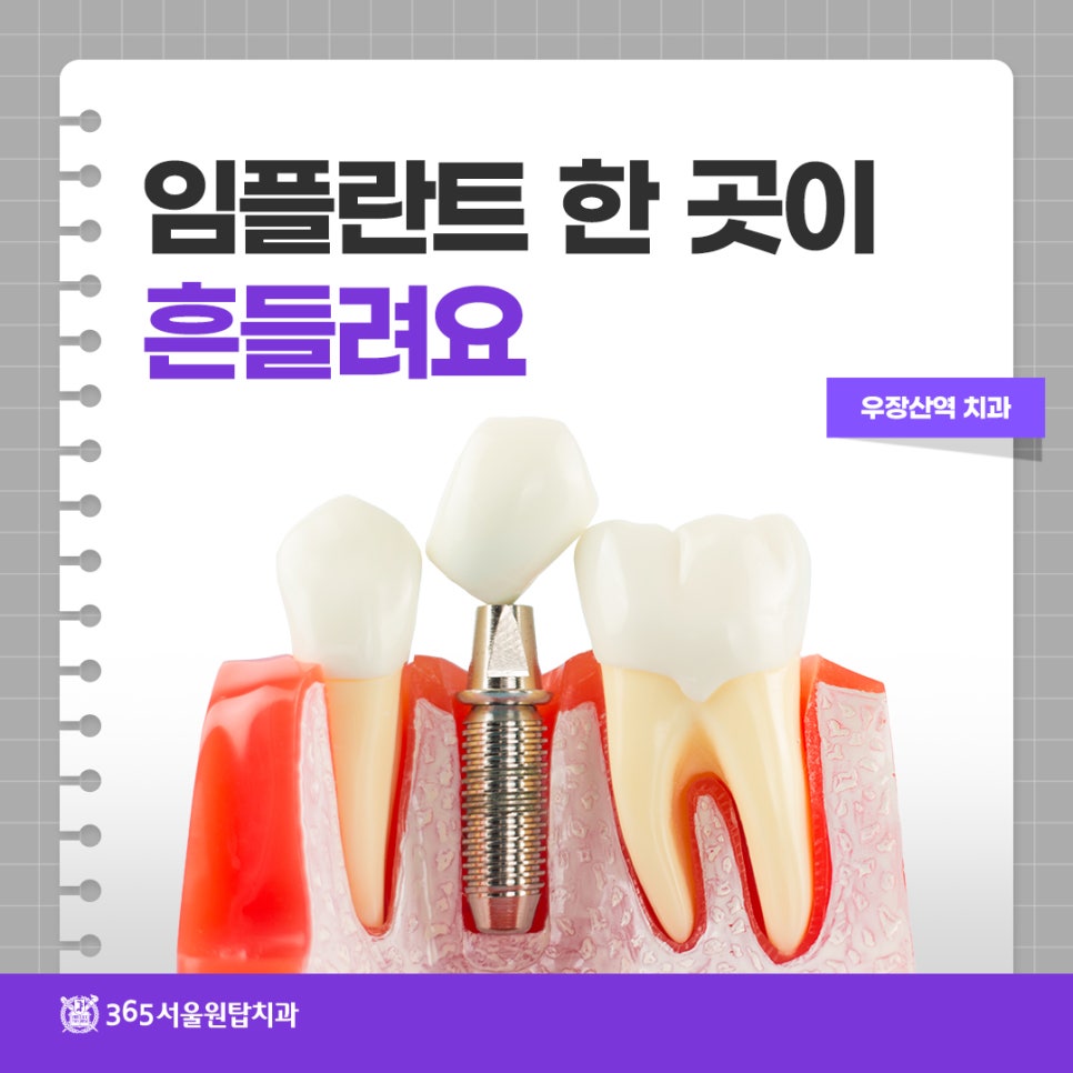 우장산역치과, 임플란트 한 곳이 흔들릴 때? 관련 이미지 9