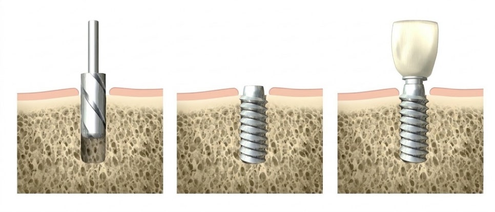 방화역치과, 임플란트 수술 시 열발생을 줄여야 하는 이유 관련 이미지 2