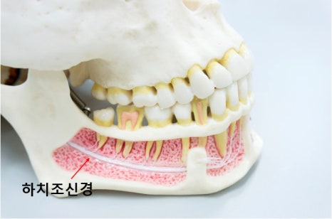화곡동임플란트, 수술 전 CT에서 꼭 확인해야하는 3가지 관련 이미지 3