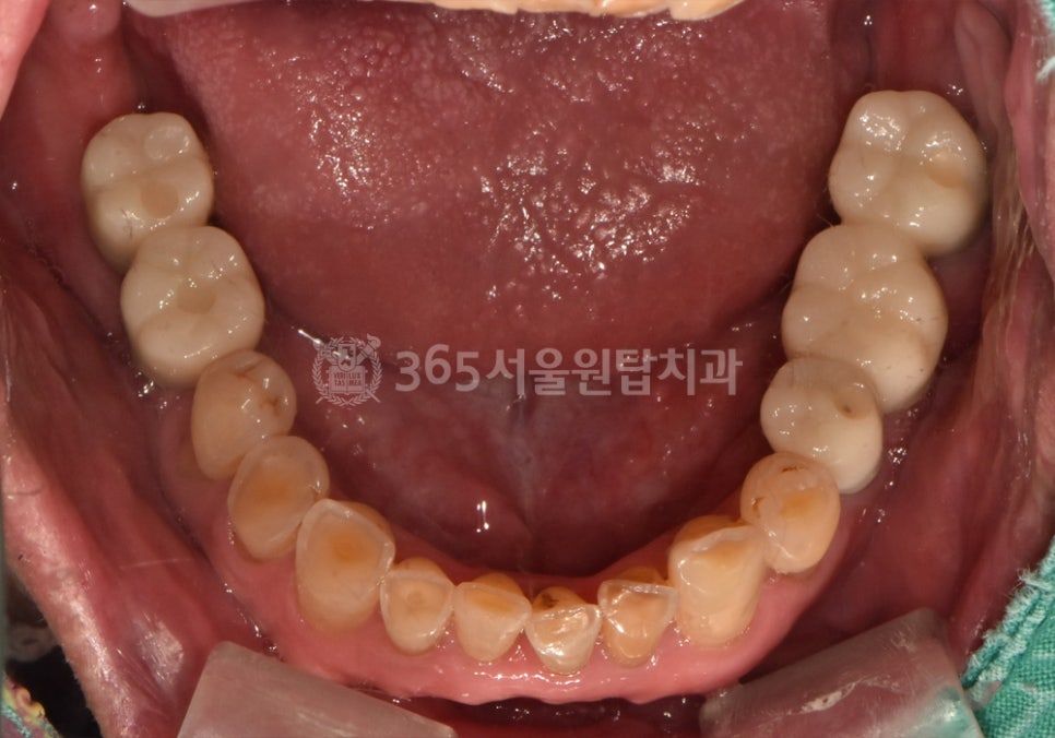 오목교 임플란트, 이갈이가 임플란트에 문제가 될 수 있나요? 관련 이미지 10