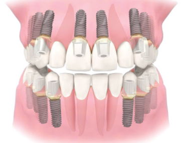 화곡역치과 치아가 빠진 개수만큼 임플란트를 심어야 될까? 관련 이미지 2