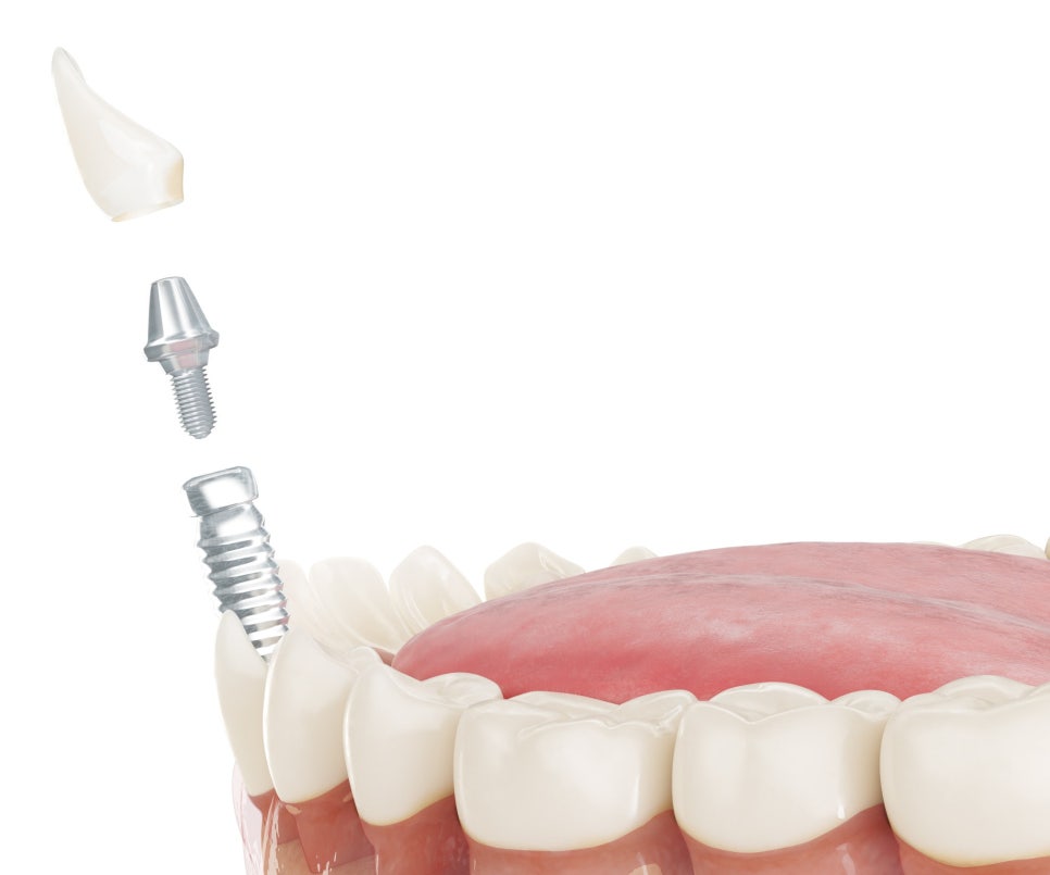 강서구 365치과, 원데이 임플란트의 모든 것 관련 이미지 6