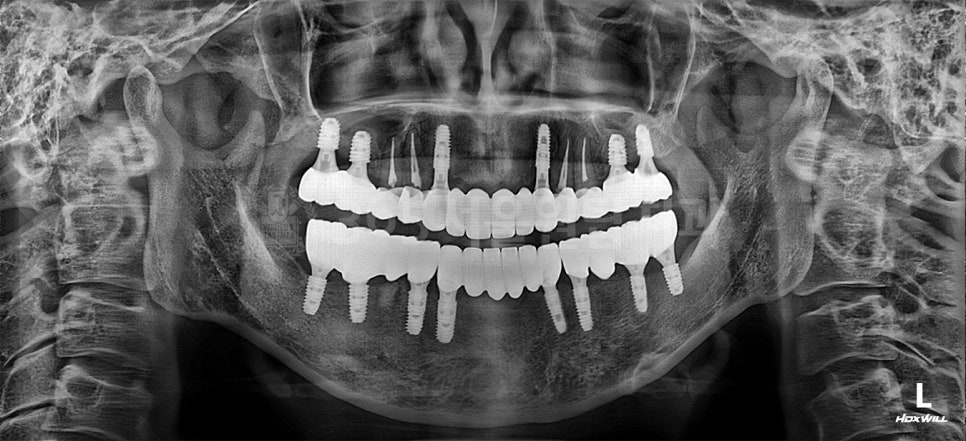 화곡동임플란트, 수술 전 CT에서 꼭 확인해야하는 3가지 관련 이미지 7