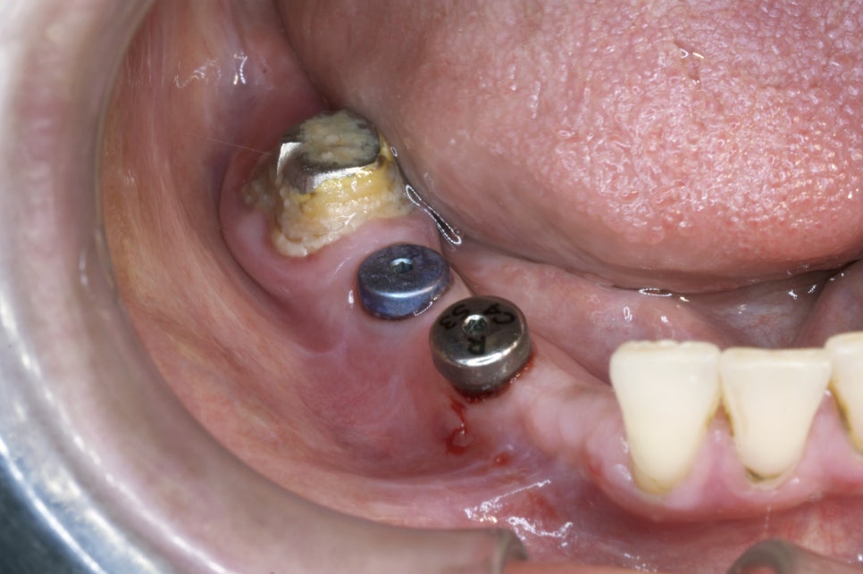 우장산역치과, 임플란트 부작용 미리 예방하세요 관련 이미지 2