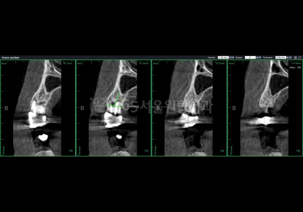 화곡동임플란트, 수술 전 CT에서 꼭 확인해야하는 3가지 관련 이미지 2