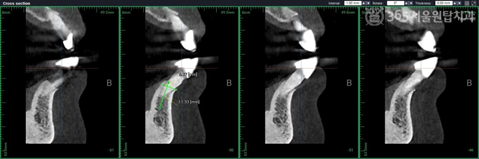 강서구 365치과, 원데이 임플란트의 모든 것 관련 이미지 5