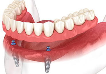 화곡역치과 치아가 빠진 개수만큼 임플란트를 심어야 될까? 관련 이미지 10