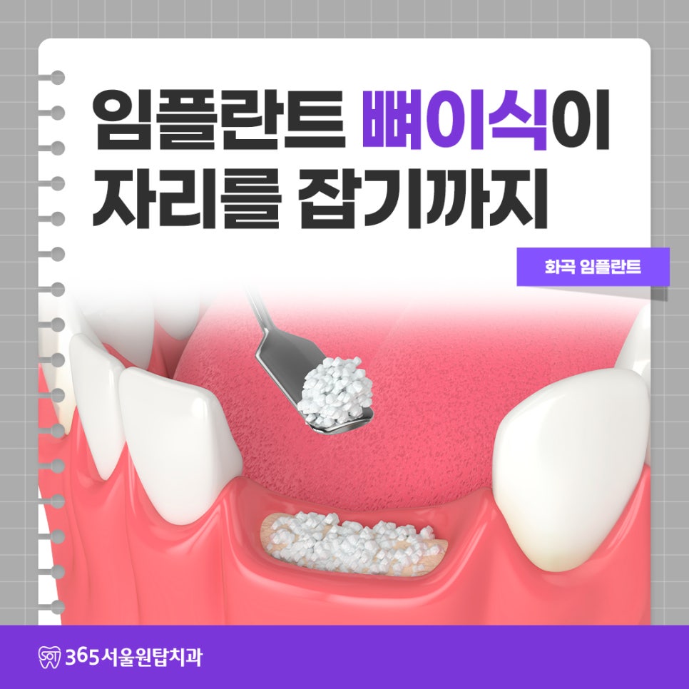 강서구 임플란트치과 , 임플란트 뼈이식이 자리를 잡기까지 관련 이미지 10