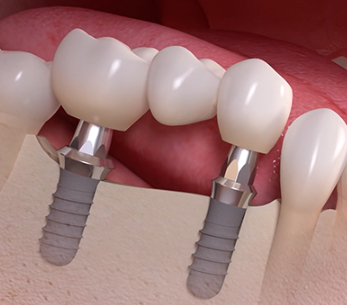 화곡역치과 치아가 빠진 개수만큼 임플란트를 심어야 될까? 관련 이미지 8