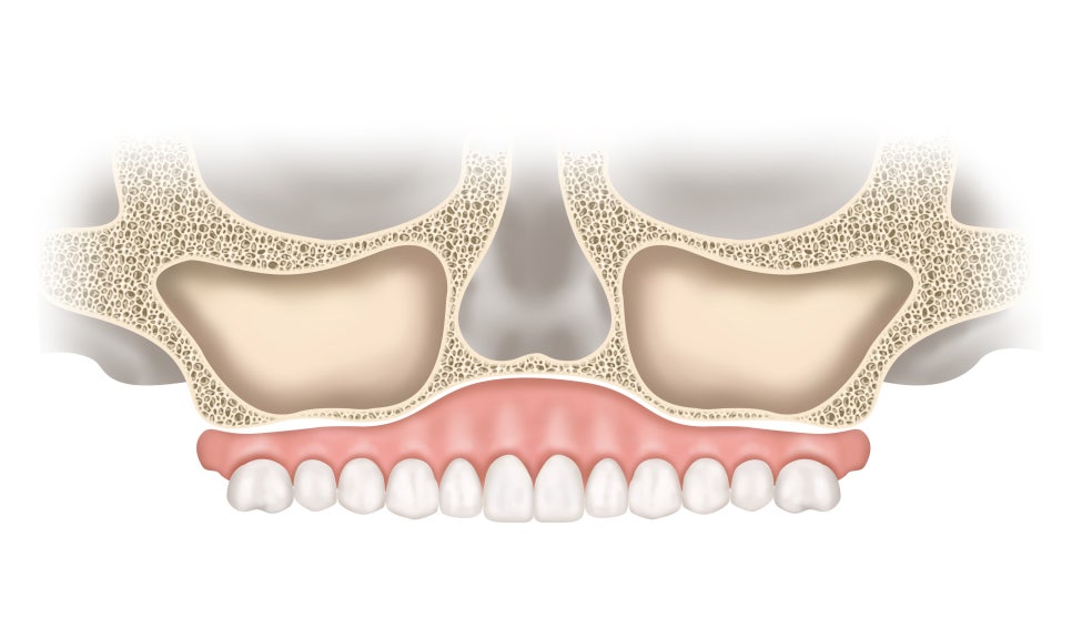 강서구임플란트, 상악동 거상술이 필요한 경우 관련 이미지 2