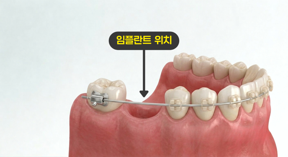 목동역치과, 임플란트와 치아교정 둘 다 가능할까? 관련 이미지 5