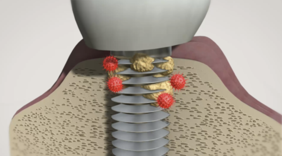 강서구청치과 임플란트 오래 쓰려면 피해야할 이것 관련 이미지 4
