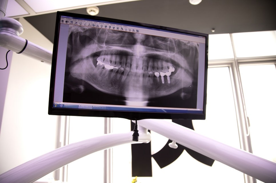 가양동치과 임플란트 상담, 제가 가장 먼저 확인하는 것 관련 이미지 2