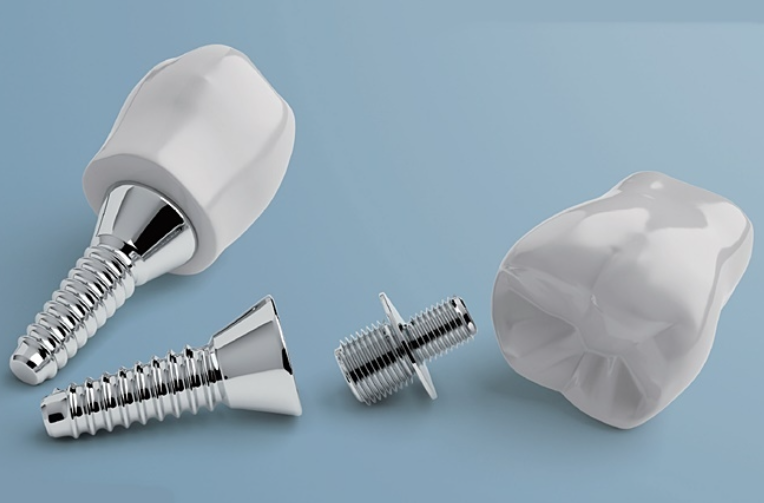 신월동치과 임플란트 심는 자리만 보면 안 되는 이유 관련 이미지 4