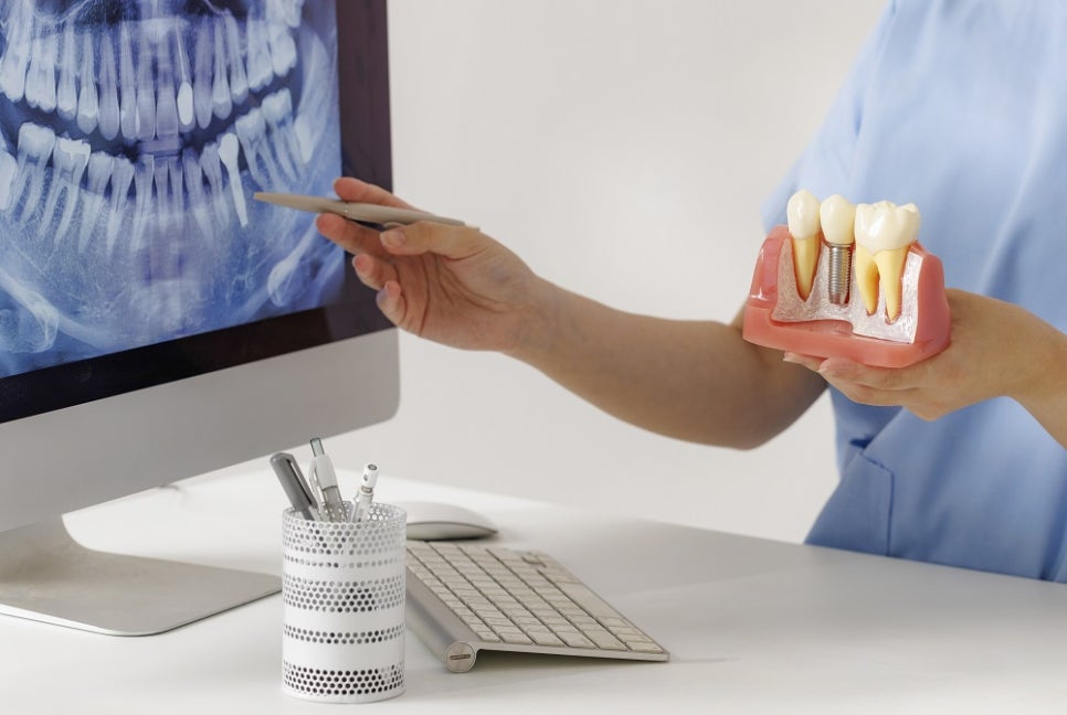 염창역 임플란트, 식립 각도의 차이가 치료 결과를 좌우합니다 관련 이미지 3