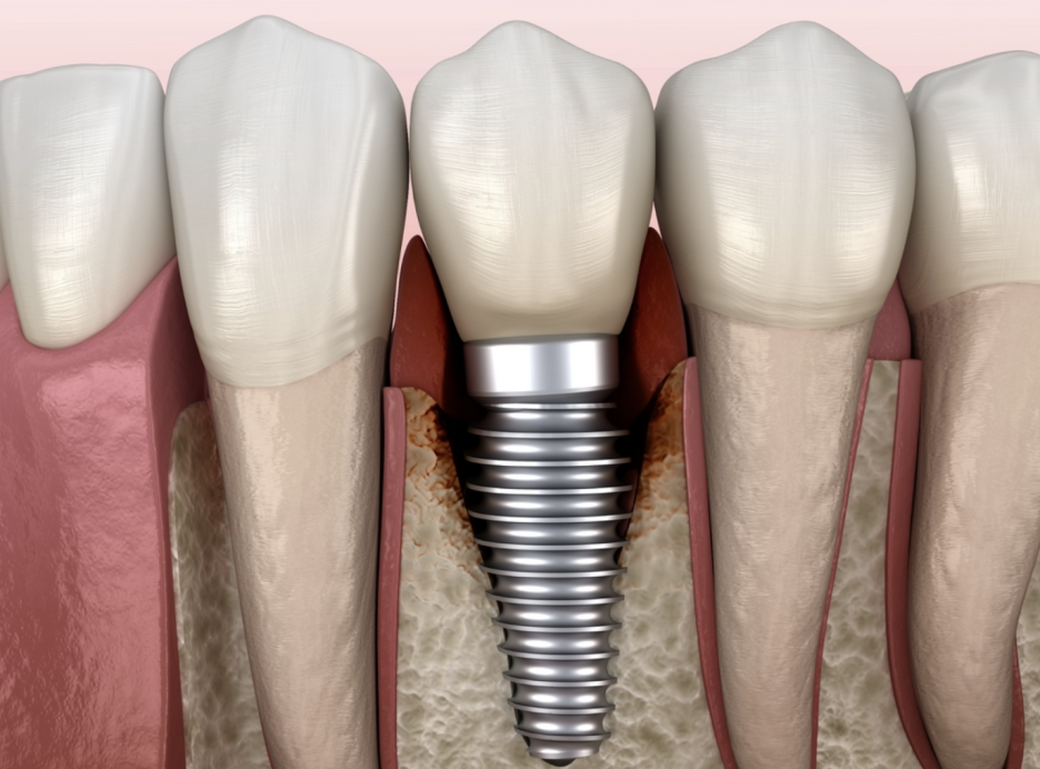 강서구청치과 임플란트 오래 쓰려면 피해야할 이것 관련 이미지 2
