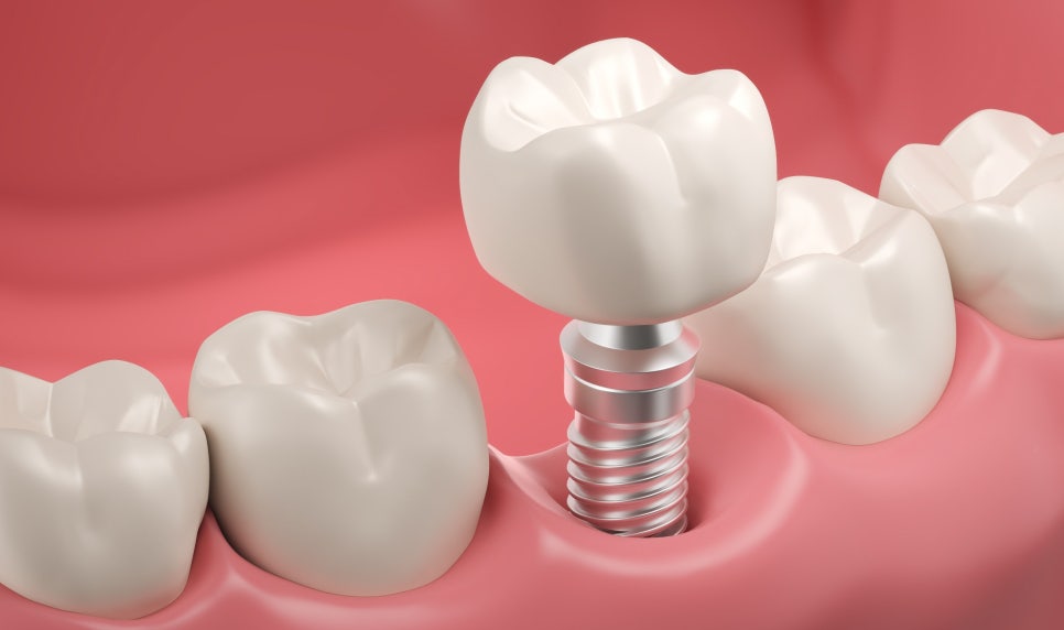 Kkachisan Dental Clinic: Which Is More Challenging, an Anterior or Molar Implant? image 2