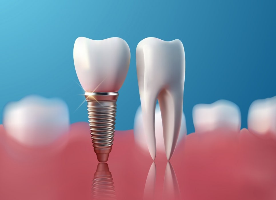 우장산역치과, 임플란트 부작용 미리 예방하세요 관련 이미지 6