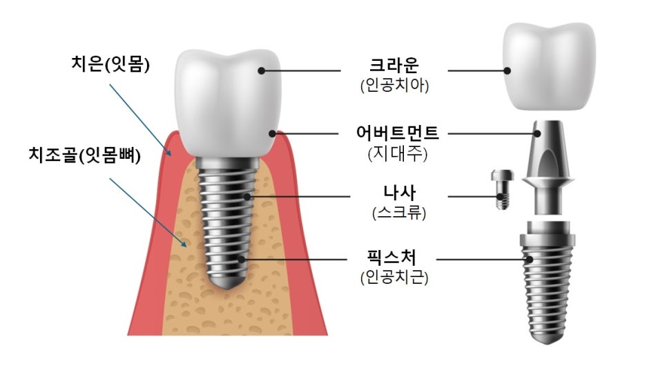 염창동치과 임플란트 주위염과 치주인대, 자연치아와 다른 이유 관련 이미지 3