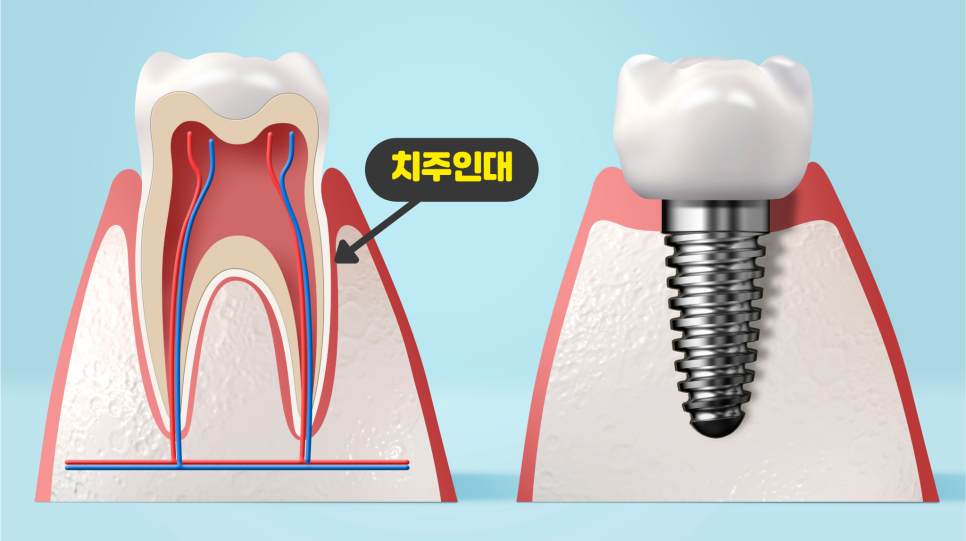 목동역치과, 임플란트와 치아교정 둘 다 가능할까? 관련 이미지 4