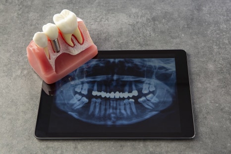 신월동치과 부모님 임플란트, 어떤 기준으로 치료할까 관련 이미지 3
